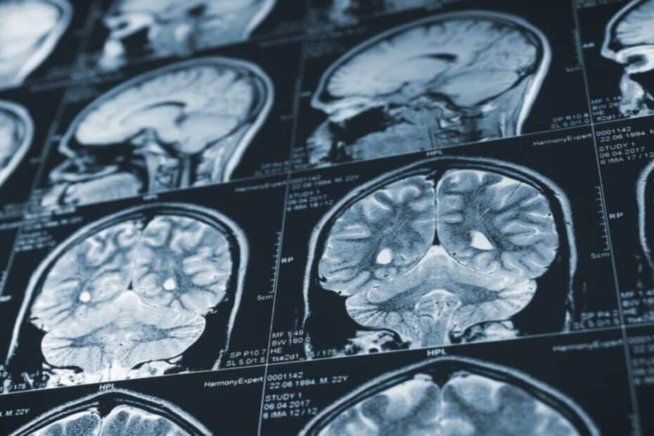 Proving Negligence in Brain Injury Cases